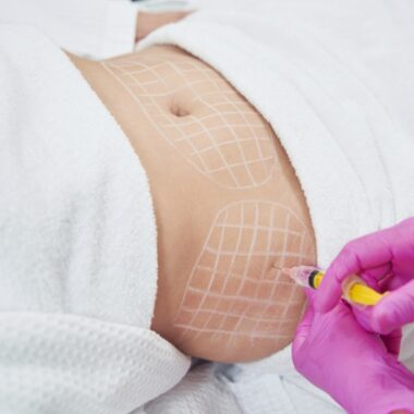 Tiêm Tan Mỡ Giảm Cân